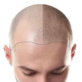 Hair Loss Tattoo